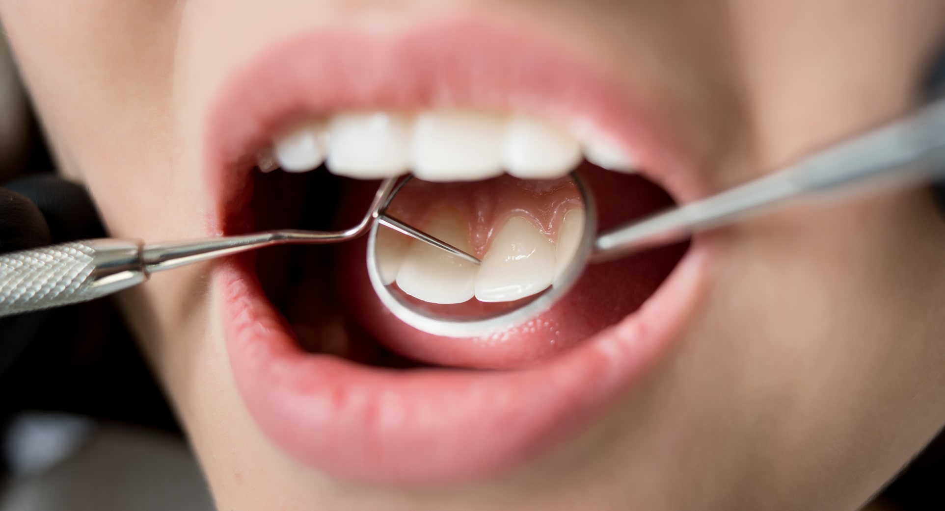 Dental implants in Corfe Mullen from Whitehall House Dental