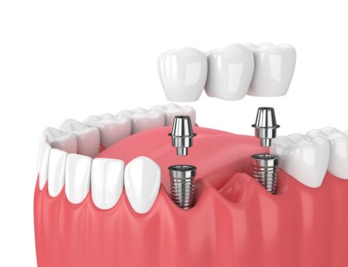 FAQs about dental implant treatments