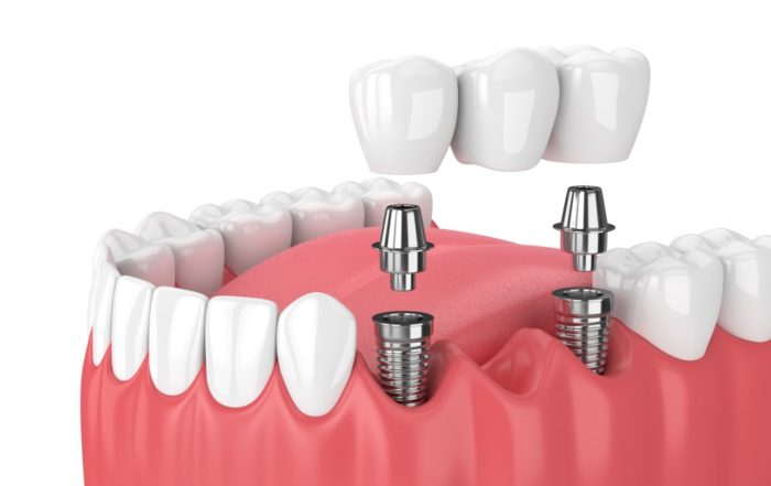 Dental implants Swanage