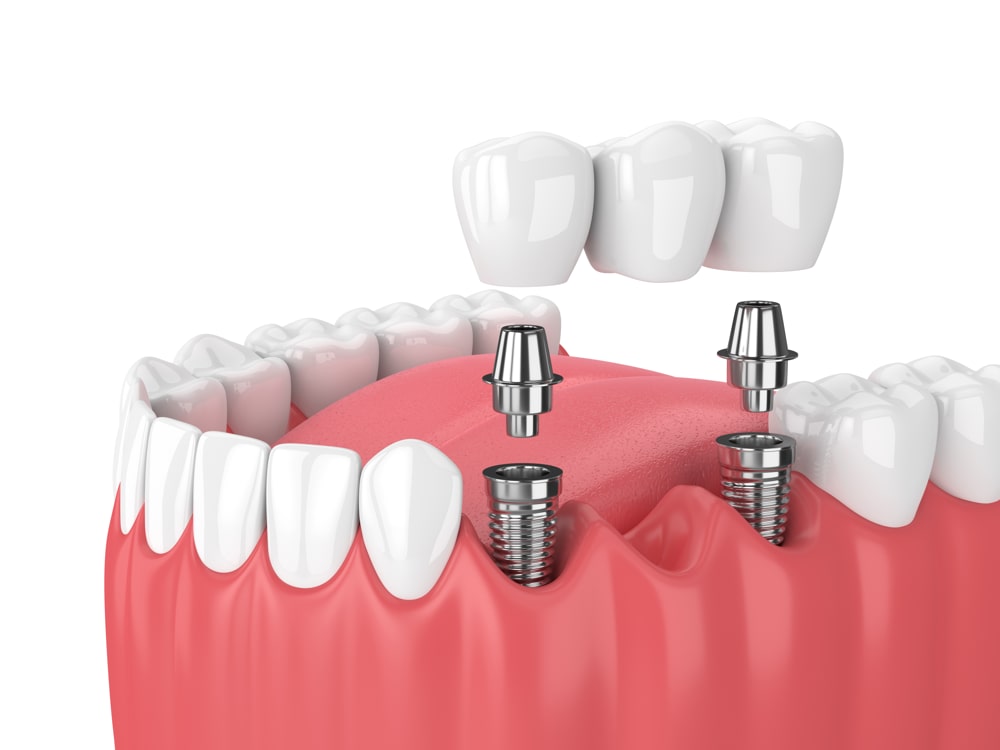 Dental implants Swanage