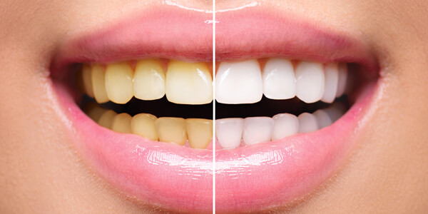 Teeth whitening treatment Corfe Mullen