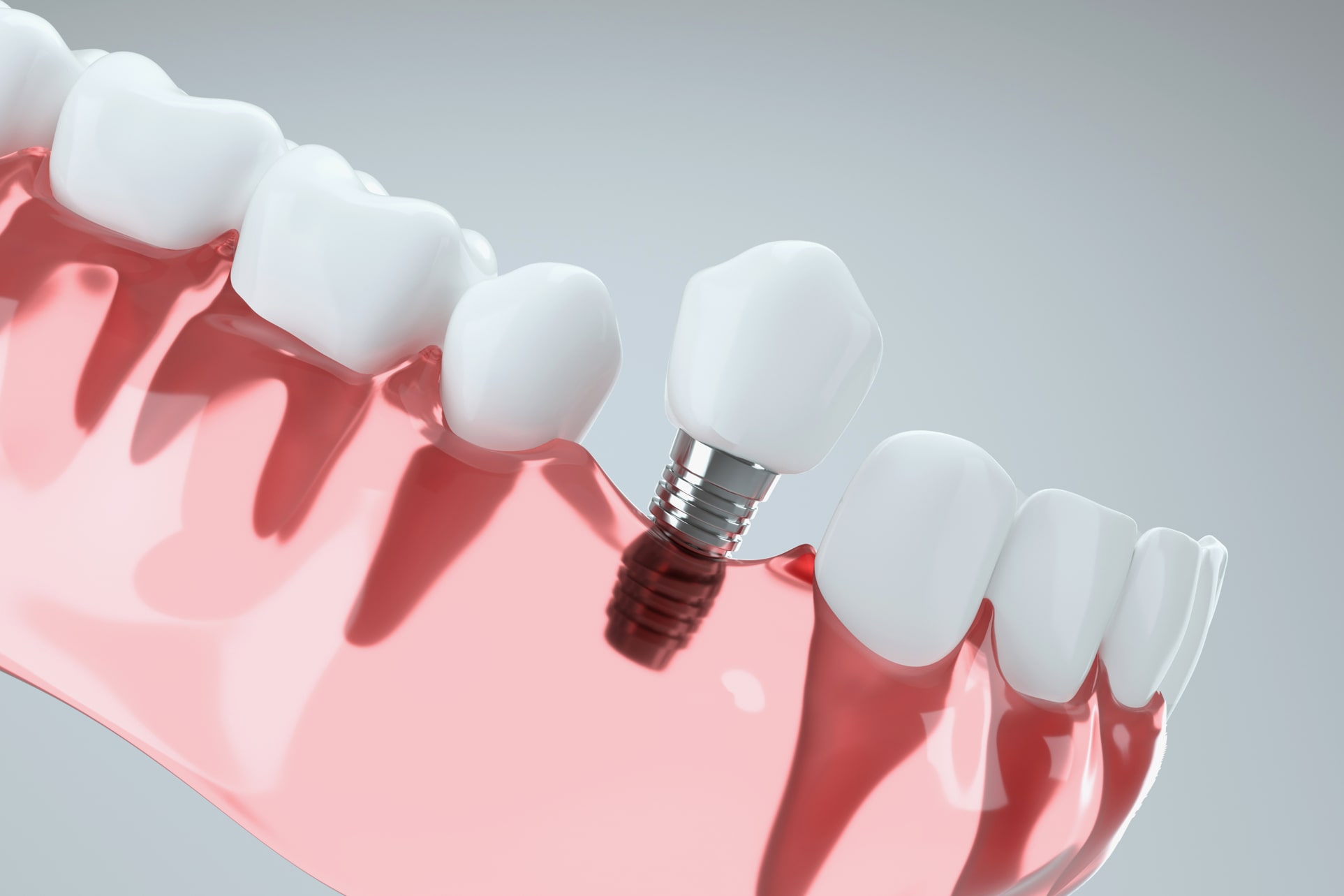 Dental implants in Verwood from Whitehall House Dental