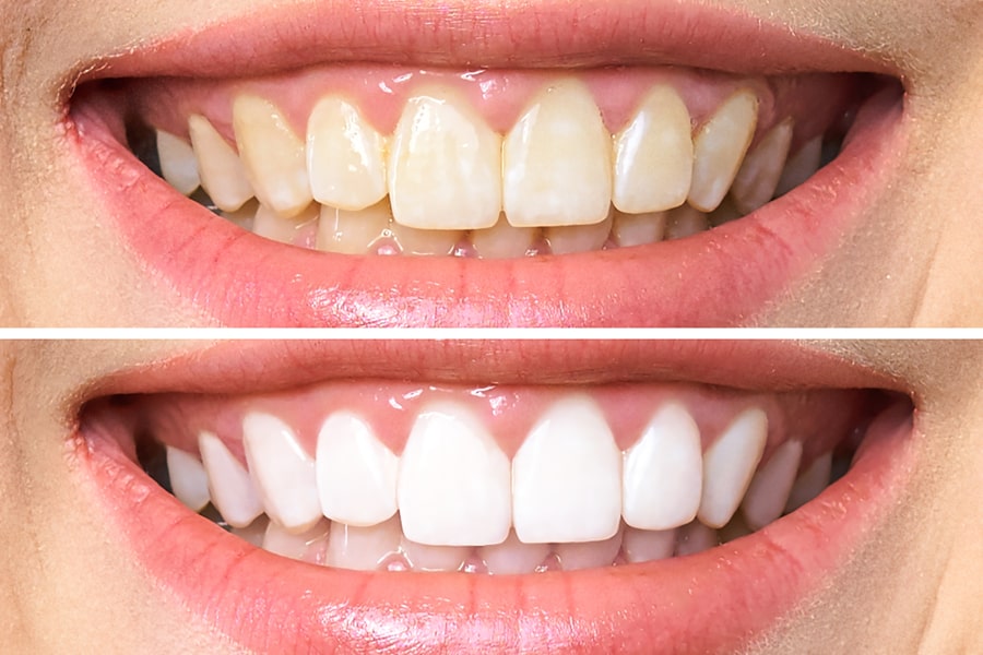 Tooth whitening wimborne,